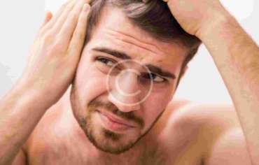Going Bald Too Young? Top Tips From The Experts!